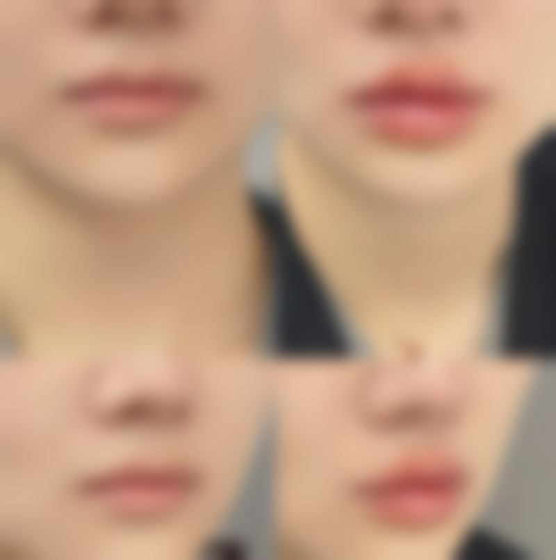 打瘦脸针需要注意什么