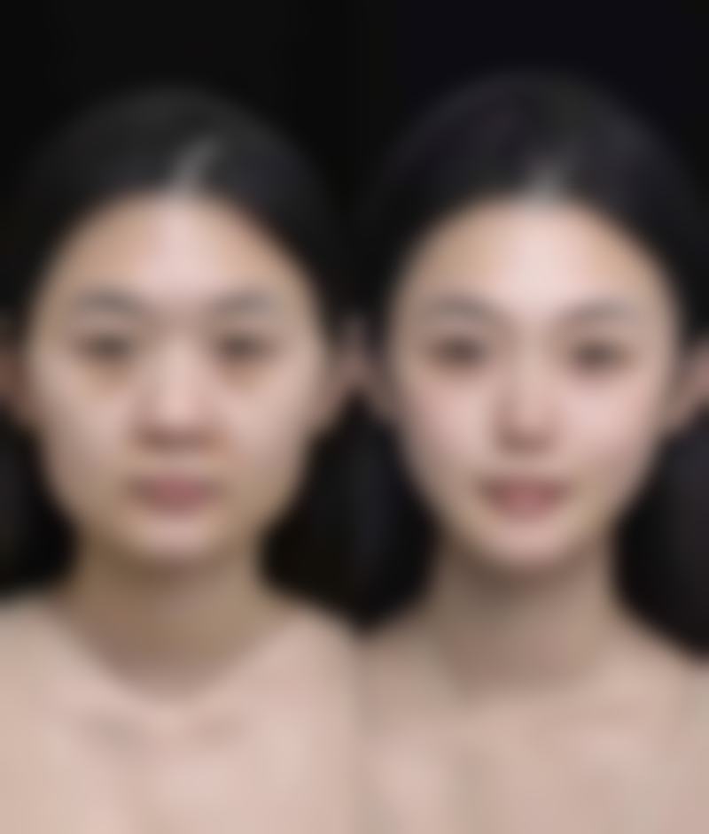 毛发种植有害吗