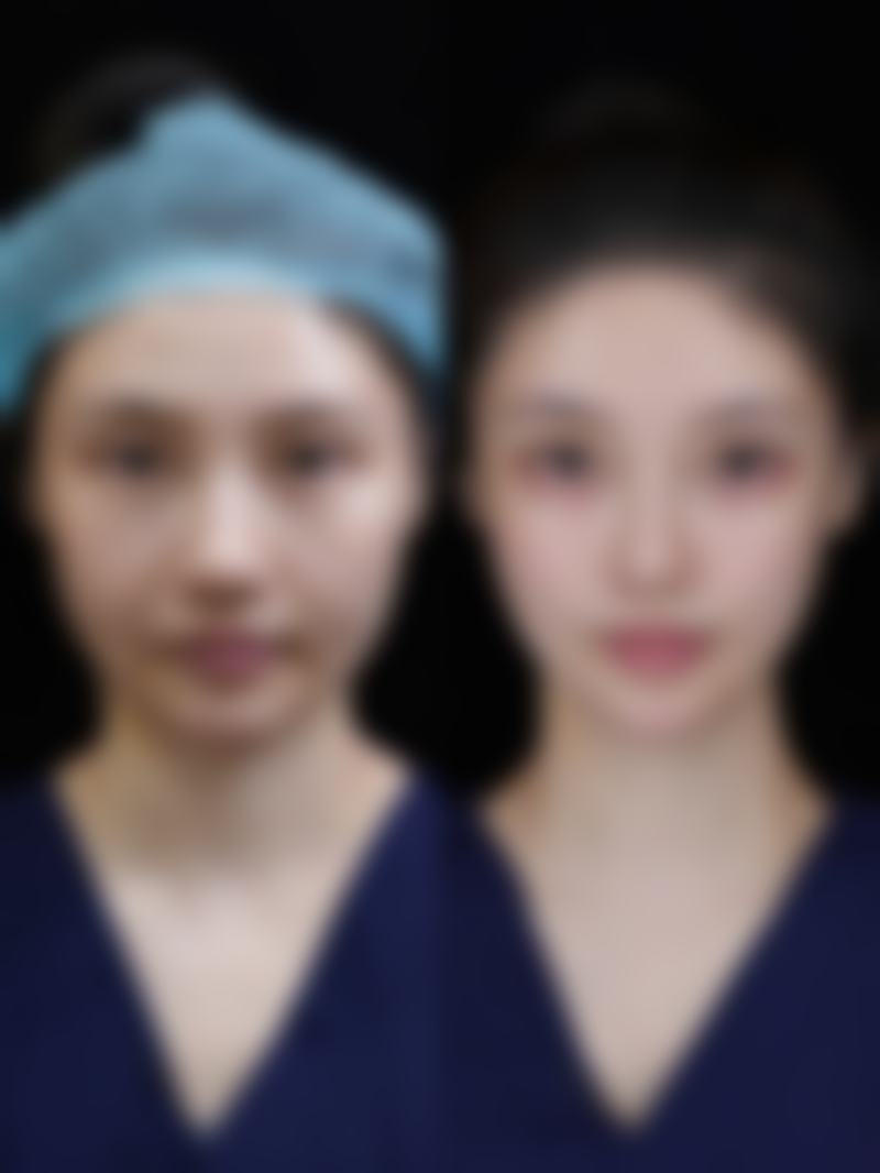 瘦脸针越打越大怎么办