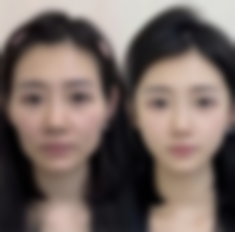 打瘦脸针出现大小脸有修复的吗