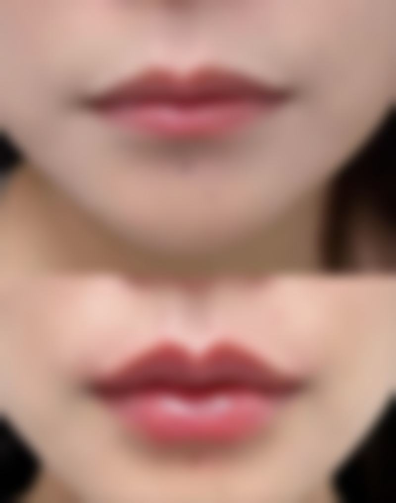 瘦脸针 20 天了能打新冠疫苗吗