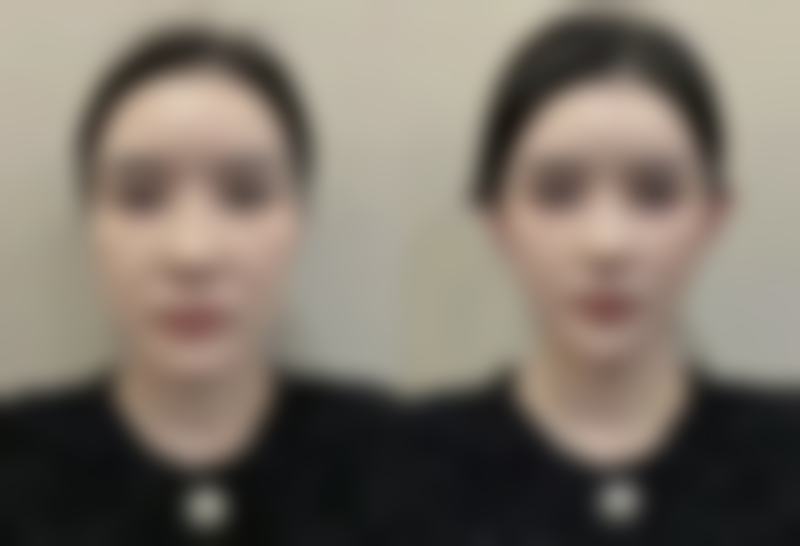 瘦脸针20天可以汗蒸吗？专业解读告诉你20天这个节点汗蒸对瘦脸效果的影响及注意事项！ 