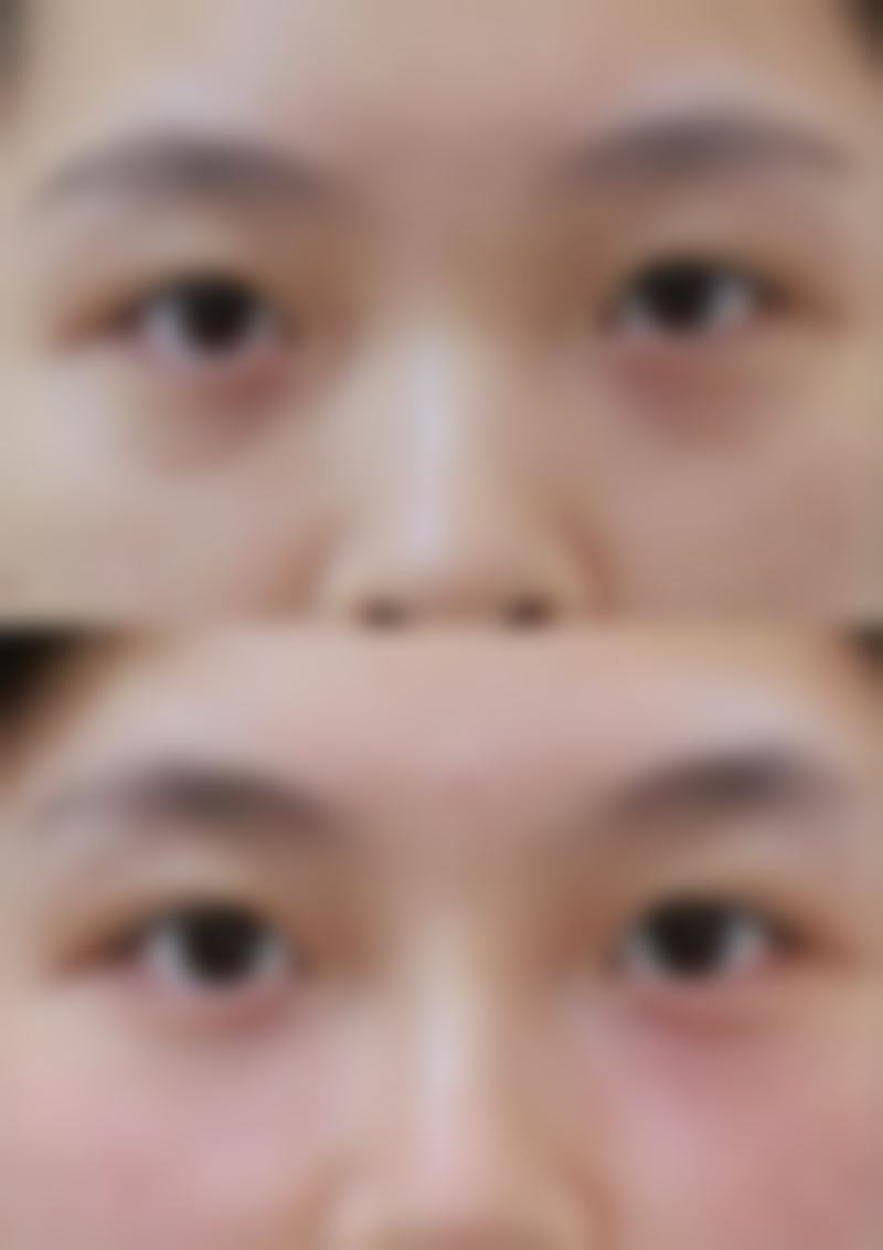 植发后毛囊稳固的阶段