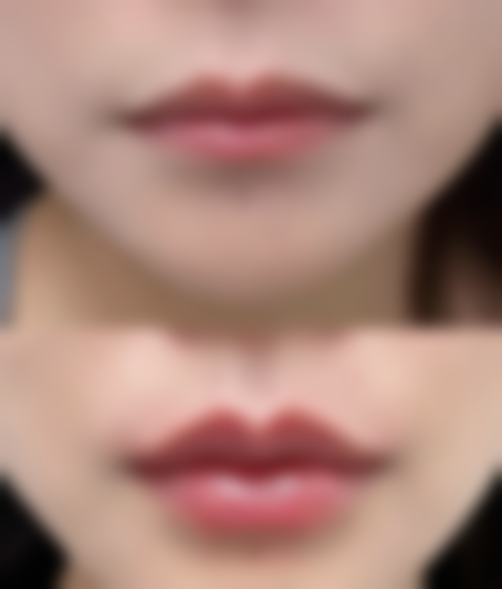 阴道紧缩术需要修复多久