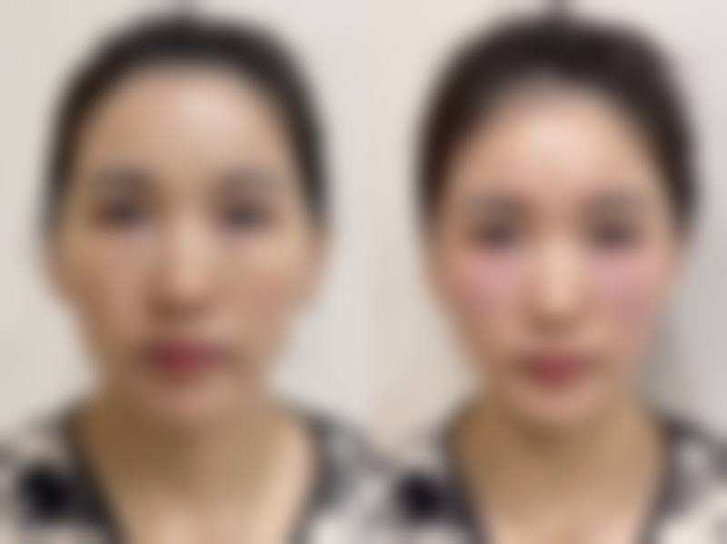 美白针真的能变白