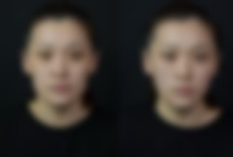 阴道紧缩术做了有副作用吗，有害吗