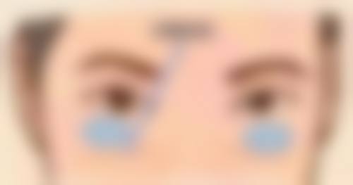 打完瘦脸针脸颊凹陷能修复到以前的样子吗