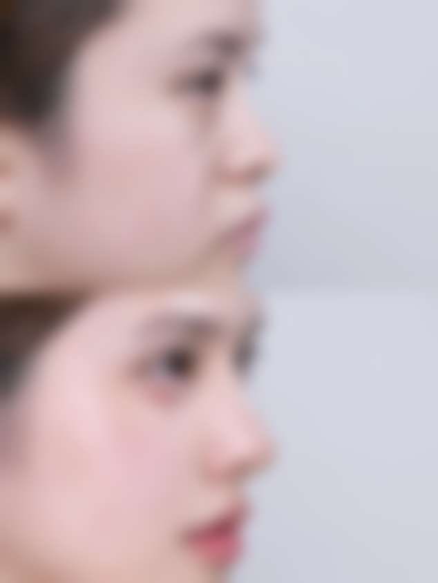 打完瘦脸针8天了感觉脸还是肿的