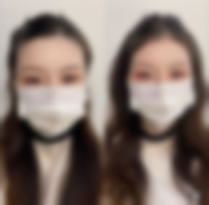 打完瘦脸针多久成效更明显