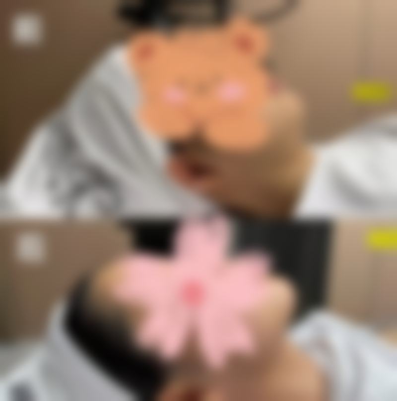 毛发种植的后续注意事项