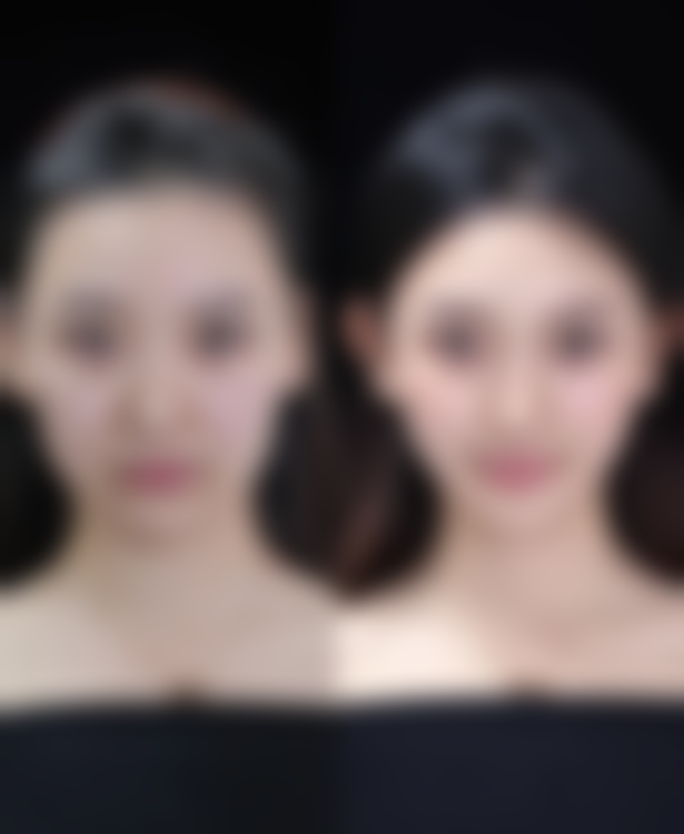 瘦脸针打一次维持多久