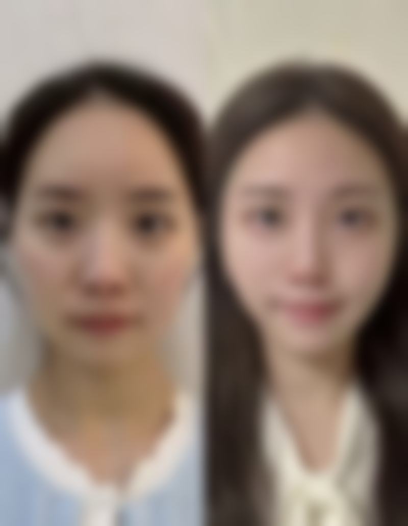 丰太阳穴用哪种玻尿酸好？揭秘3种热门玻尿酸特性，助你轻松选对适合自己的填充材料！ 