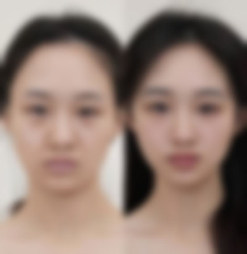 瘦脸针在哪里打