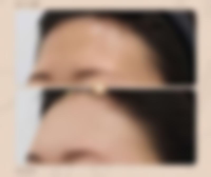 瘦脸针打一次维持多久