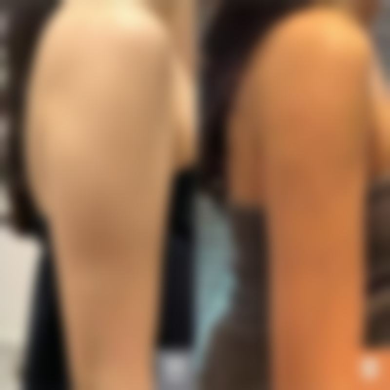 瘦脸针打完多久见效