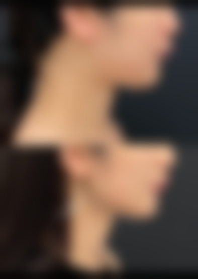 瘦脸针多久打一次成效至佳