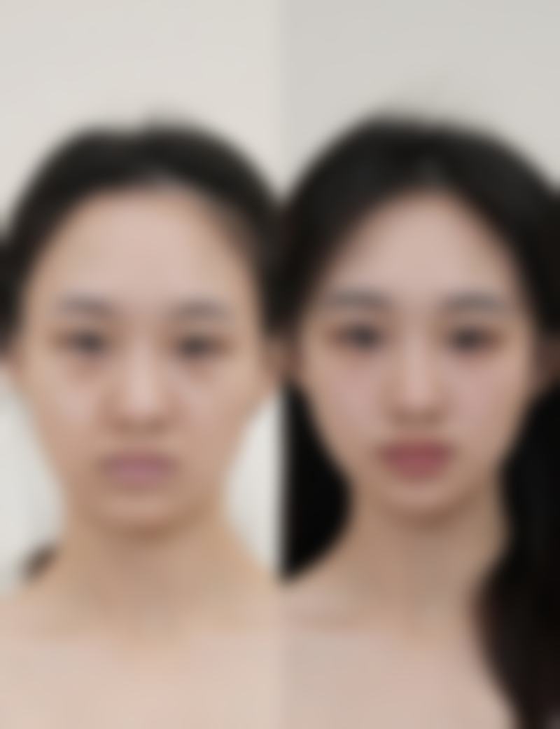 打瘦脸针需要注意什么