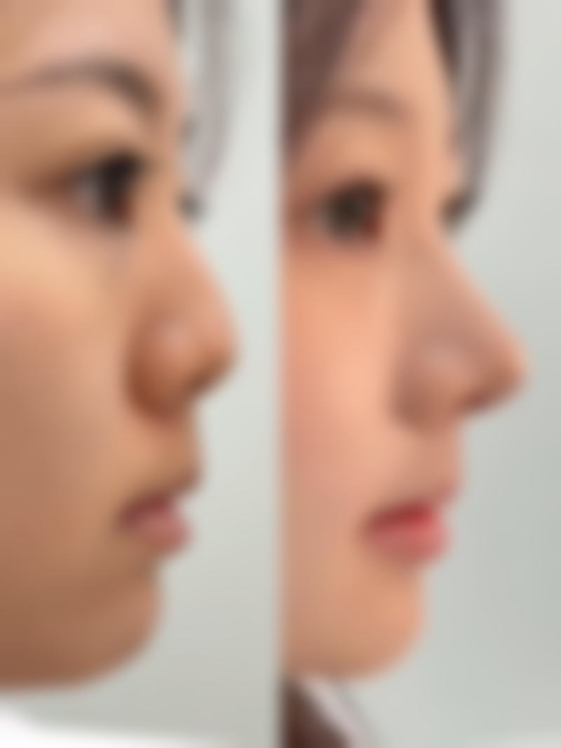 瘦脸针一般打50单位还是100单位？