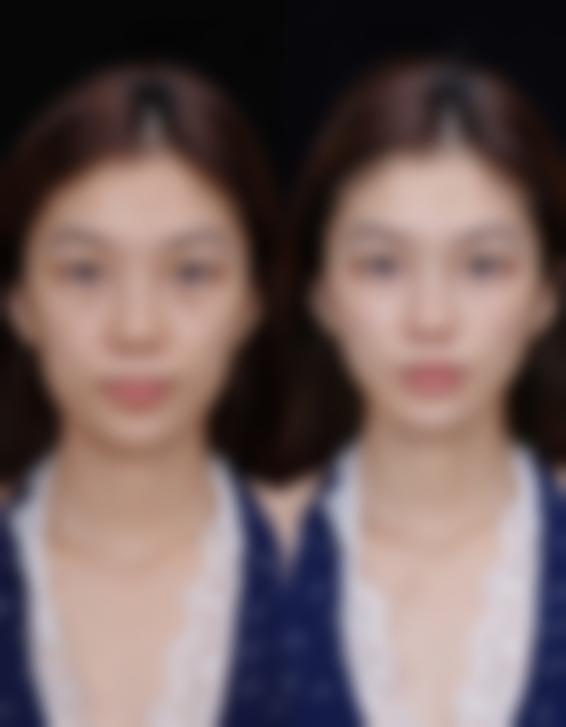 南京打除皱针有副作用吗？揭秘3大常见误区，正确打法让你安全抗衰，年轻10岁不是梦！ 