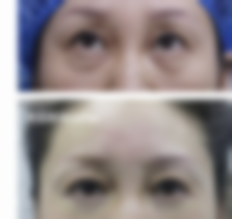 南京打除皱针有副作用吗