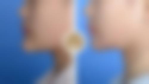 环切包皮手术多少钱