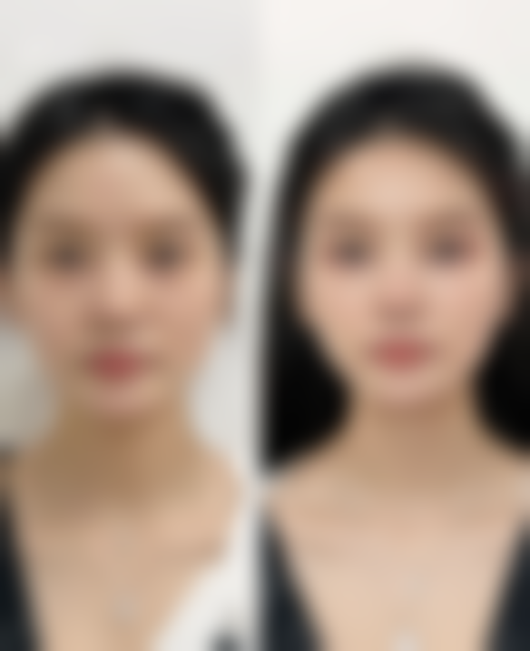 种植头发大概多少钱