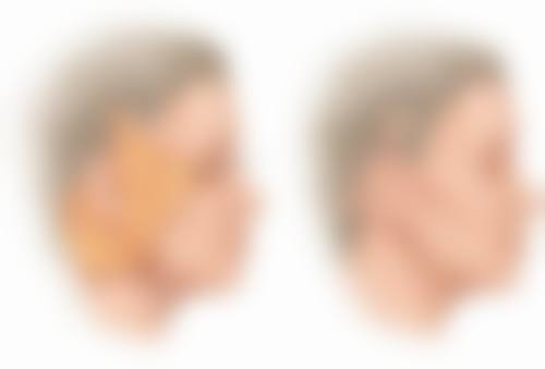 瘦脸针一般打50单位还是100单位