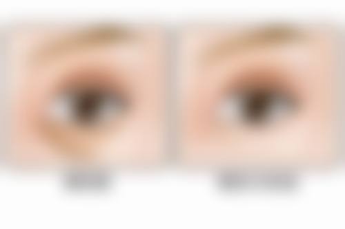 打完瘦脸针8天了感觉脸还是肿的