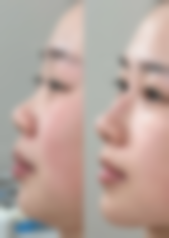 生孩子后可以做紧缩术吗