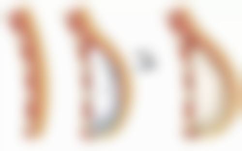 拉皮手术有风险吗