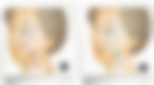 可以种植人工假发吗？和植发有区别