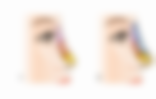 拉皮手术一般多少钱、价格一览表