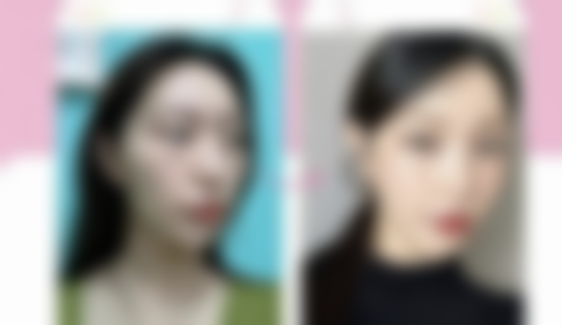 海薇玻尿酸适合打哪里？