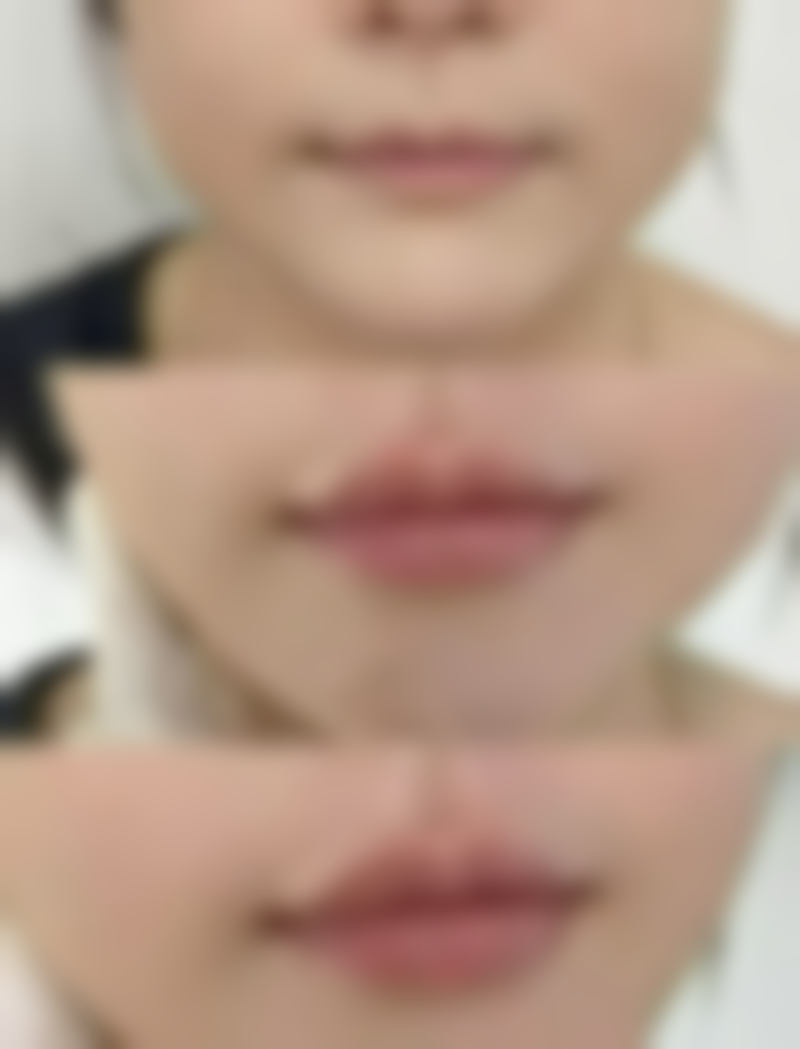 人工种植头发手术多钱？不同方式价格不同