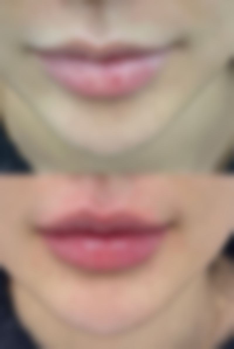 男生嘴唇厚怎么变薄图片