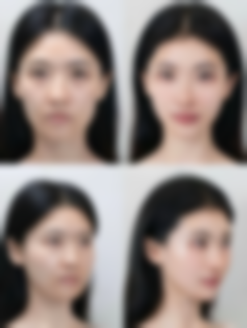 除皱针能瘦脸吗