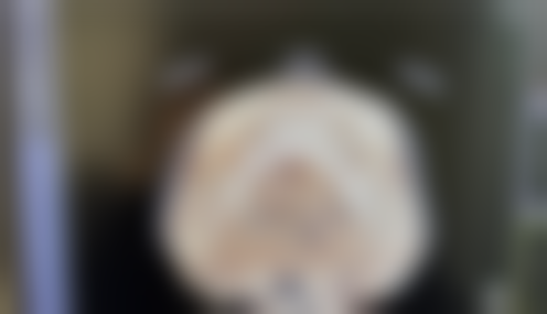 种植的毛囊可以拿掉吗