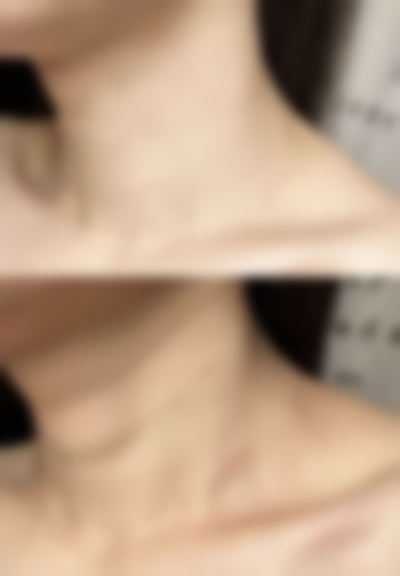 青岛瑧妍美医疗美容医院金哲做疤痕修复成效如何？