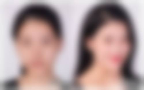 美白针有哪些注意事项