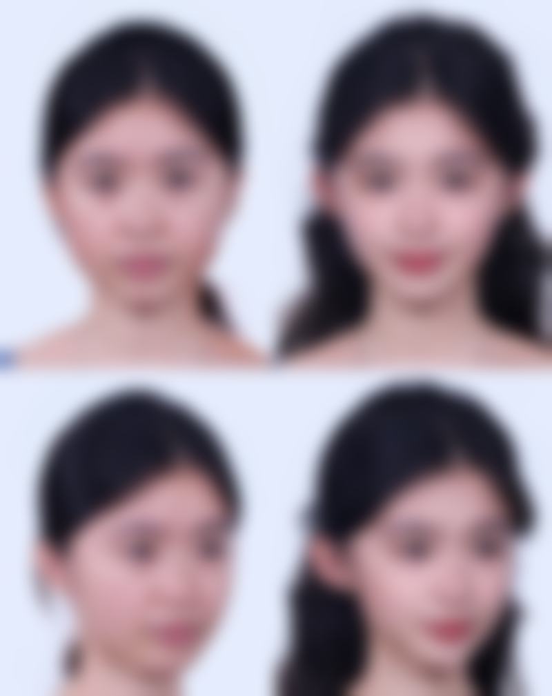 进口与国产瘦脸针的区别