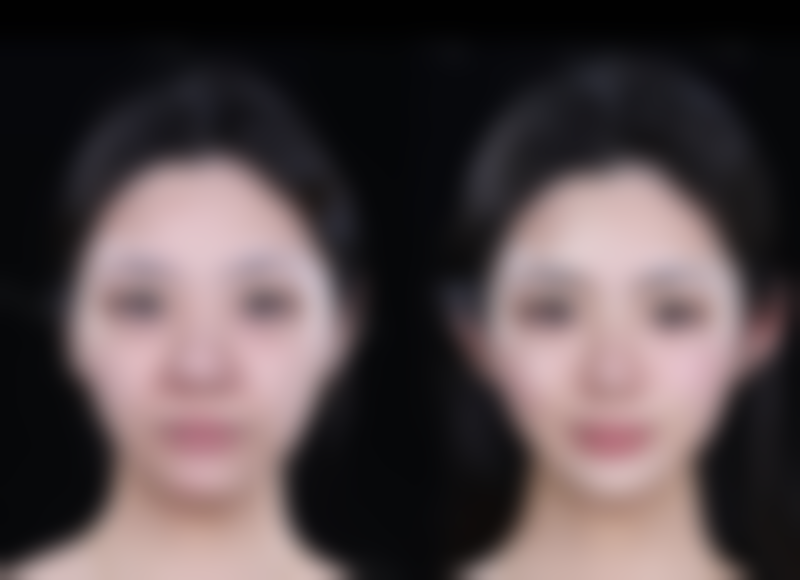 重庆铜雀台瘦脸针的优势