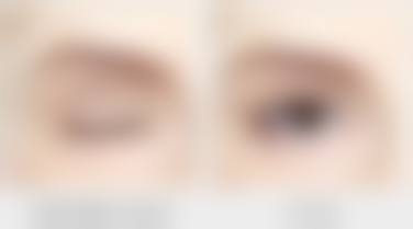 瘦脸针打咬肌维持多久