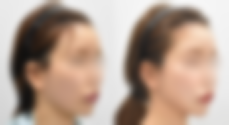 打瘦脸针管用吗能挺多久