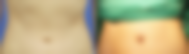 下巴后缩矫正多少钱