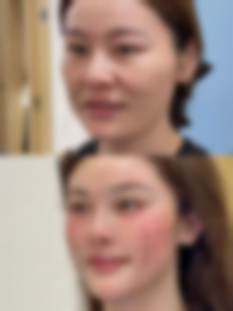 毛发种植成功几率高吗