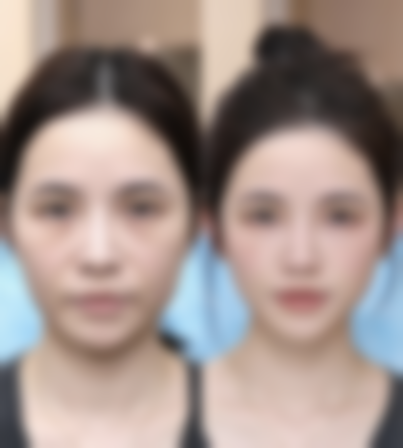 光子嫩肤相关问题