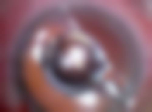 选择自体脂肪填充项目的注意事项