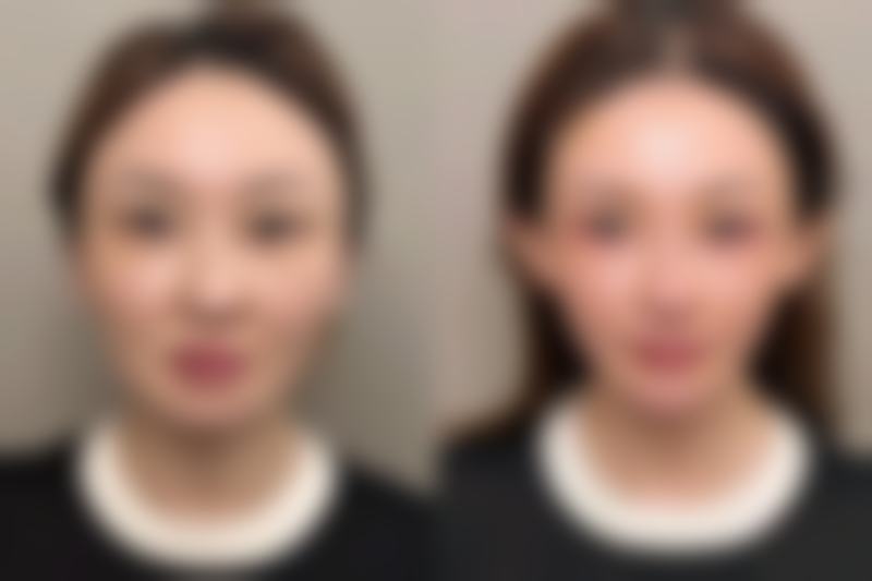 自体脂肪丰太阳穴是安全的吗？权威解析：三大理由证明它是安全有效的医美方式，放心变美！ 