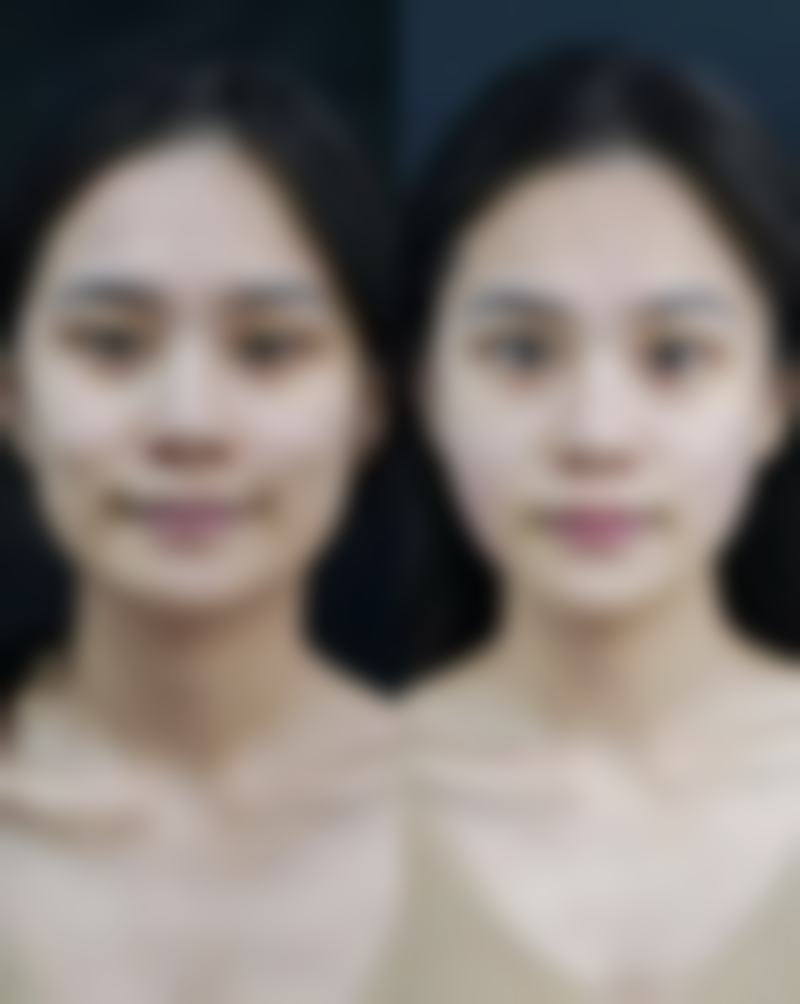 四、下颌骨整容风险大吗