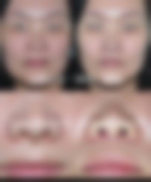 鼻部整形也是医院的热门项目之一。一个好看的鼻子能够改善面部的立体感和协调性。青岛善慈整形医院在鼻部整形方面有着丰富的经验，医生会根据患者的鼻梁高度、鼻头形状等因素，进行综合设计，打造出自然美观的鼻子。